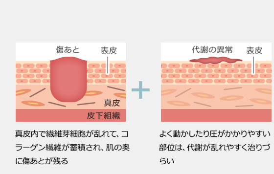 真皮内で繊維芽細胞が乱れて、コラーゲン繊維が蓄積され、肌の奥に傷あとが残る・よく動かしたり圧がかかりやすい部位は、代謝が乱れやすく治りづらい