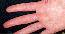 手湿疹の写真