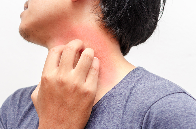 後ろ 首 湿疹 の 【医師監修】首まわりのかゆみ、湿疹、皮膚炎、かぶれの原因と対処法