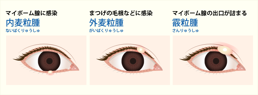 眼瞼炎とものもらいの治療
