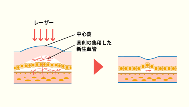 光線力学的療法