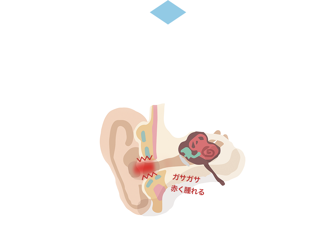 図：くり返す耳のかゆみは、耳の中の皮ふ・耳まわりが炎症を起こしているから。ガサガサ　赤く腫れる