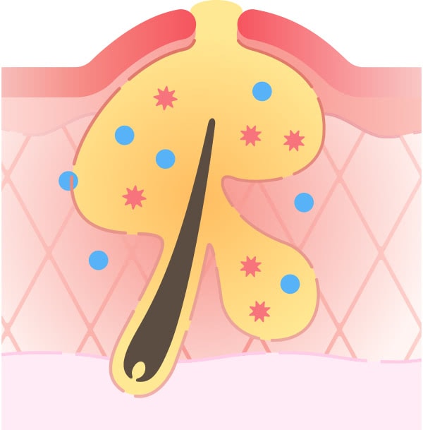 黄ニキビ：赤ニキビの後に、さらにさまざまな細菌が増えると、膿（うみ）をもった状態になります。