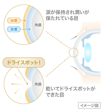 涙が保持され潤いが保たれている目 油層 液層 角膜 ドライスポット！ 角膜 乾いてドライスポットができた目 イメージ図